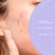 Freshly Cosmetics - Tratamiento Acné Facial Y Piel Reactiva Azelaic Radiance con 10% Ácido Azelaico 100% puro y natural. Crema ligera acné y rojeces 50ml - 4